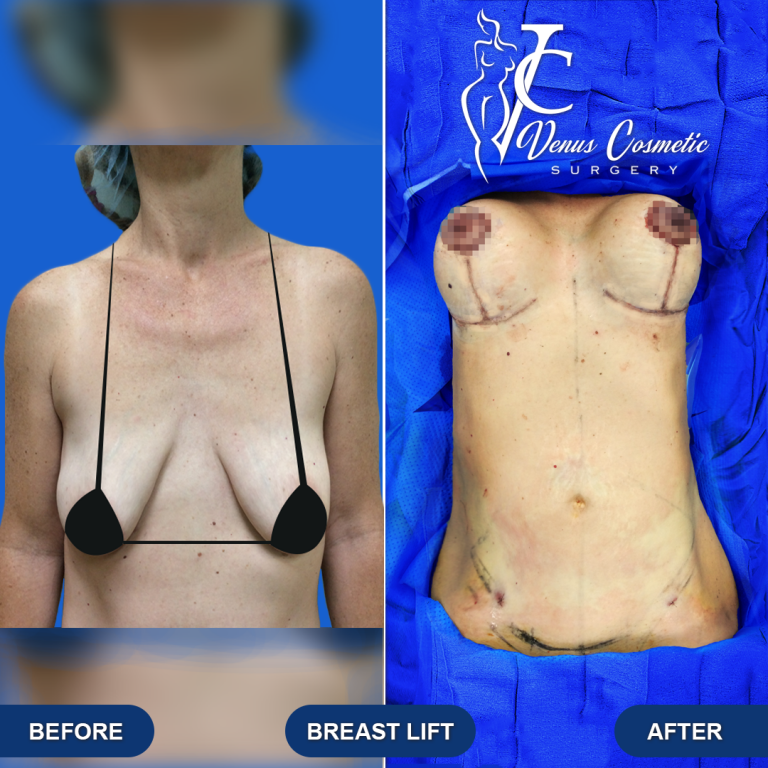 breastlift-04