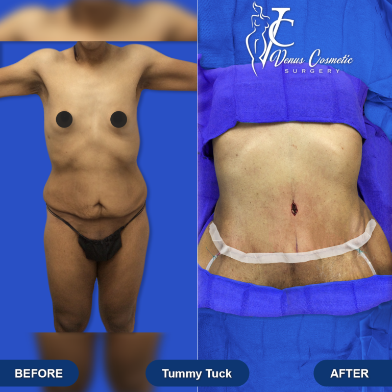 tummytuck-04